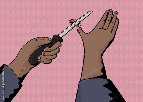 Accidentally Severing Thumb