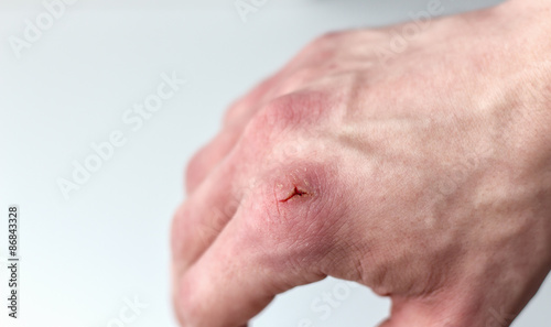 horizontal image of a close up shot of a caucasian hand with a cut on the knuckle isolated on white background. 