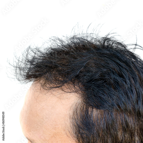 Point of focus lose one's hair glabrous baldy loss hairline men.