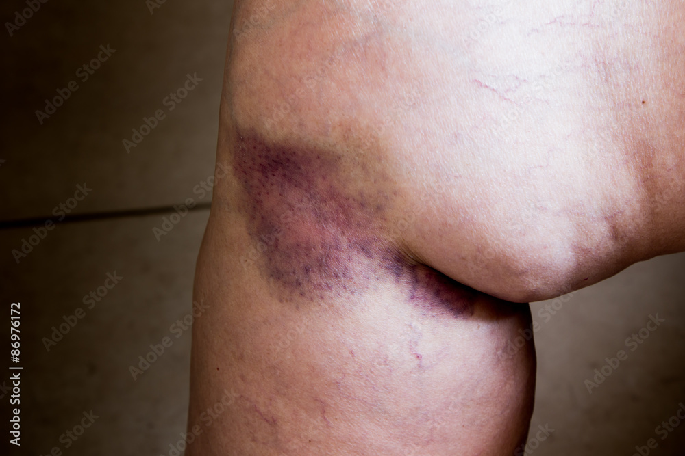 Fototapeta premium Closeup on a Bruise on wounded old woman leg skin