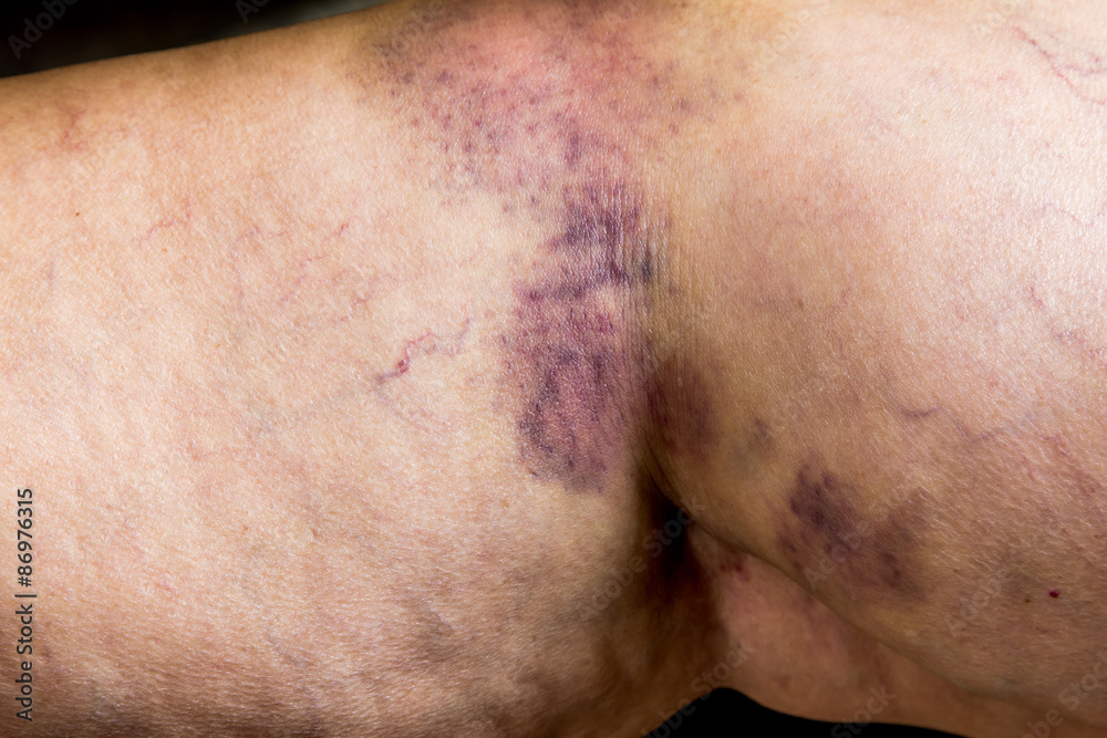Naklejka premium Closeup on a Bruise on wounded old woman leg skin