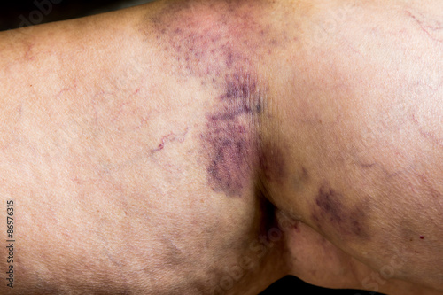 Closeup on a Bruise on wounded old woman leg skin