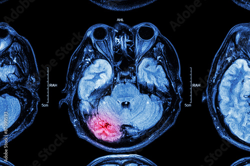 MRI of brain : brain injury