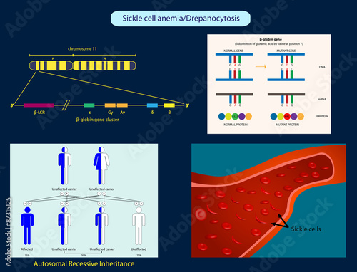 Sickle-cell anemia