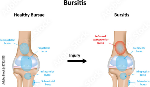 Bursitis