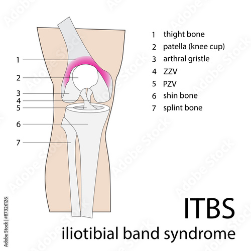 iliotibial band syndrome. vector illustration of itbs injury
 photo