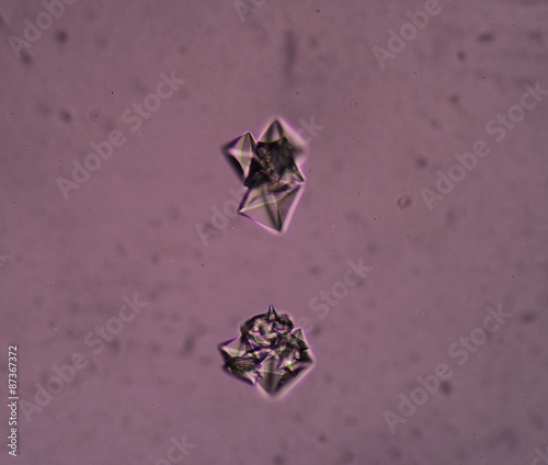 calcium oxalate crystal in urine analysis. photo