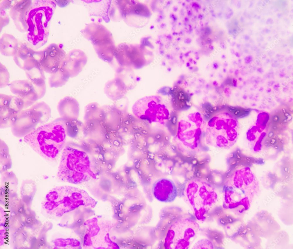 white blood cells clumping show in blood smear. Stock Photo | Adobe Stock