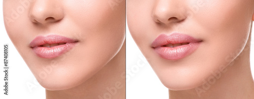 Lips  before and after augmentation