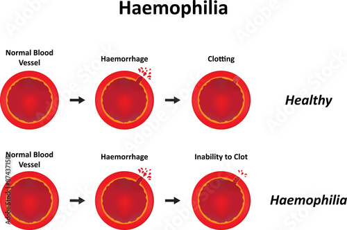 Haemophilia photo