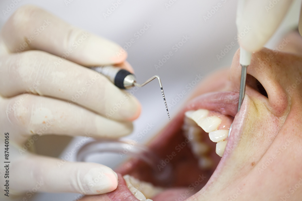 Periodontal probe for measuring pocket depths