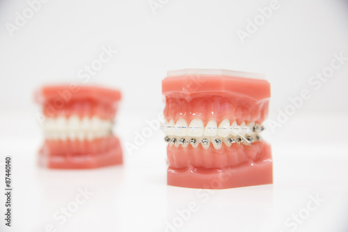 Model of human jaw with wire braces Fototapet