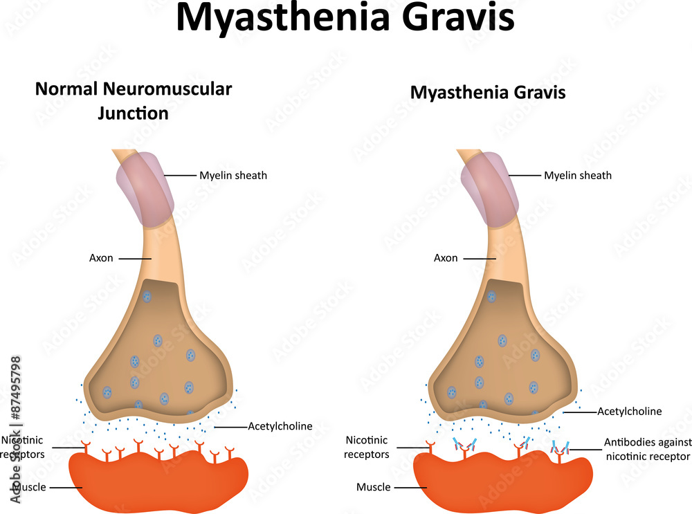 Photo &amp; Art Print Myasthenia Gravis, joshya