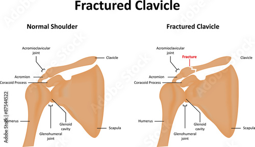 Obraz na płótnie Fractured Clavicle Bone