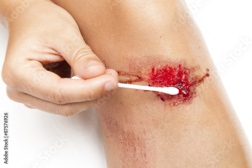 Cleaning bleeding wounds.Person with fresh bleeding wounds on the knees. Wound is cleaned with desinfected cotton stick, swab, to prevent infection. Against white background, closeup