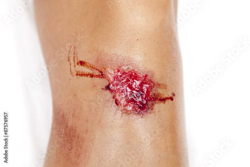 Sport injury - painful knee wound accident. Close up on an bleeding scraped human knee after skating accident. Against white background, closeup, space for text