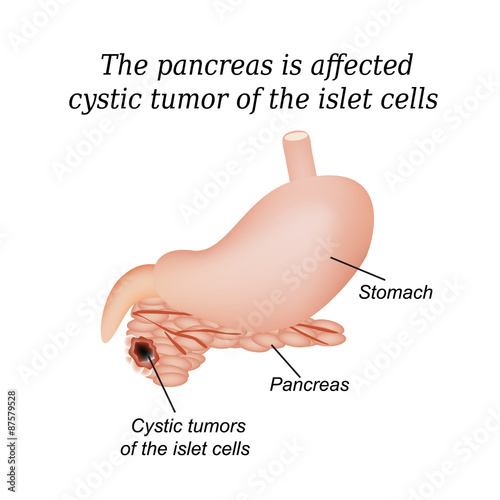 The pancreas is affected cystic tumor of the islet cells
