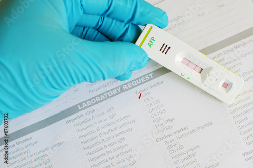 AFP (tumor marker for liver) positive photo