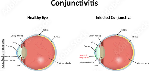 Conjunctivitis Illustration