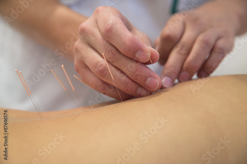 Treatment by acupuncture photo