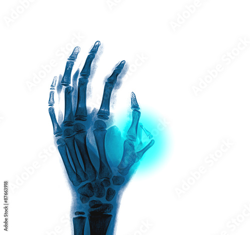 xray abnormal finger from the side, black background