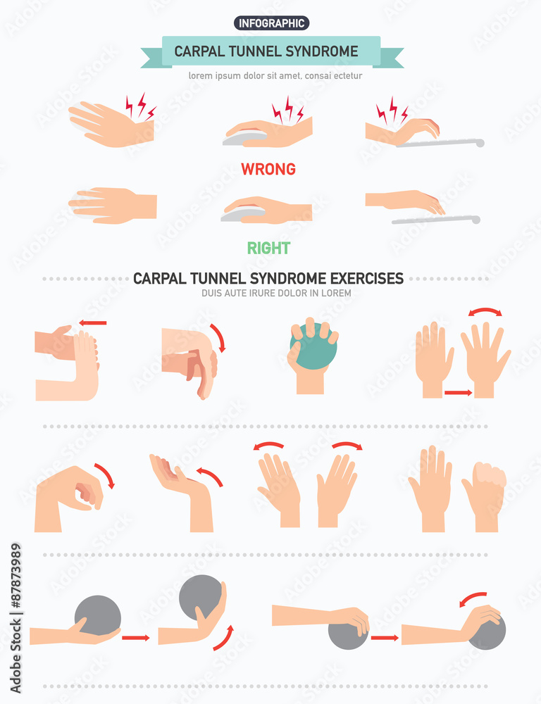 Carpal tunnel syndrome infographic