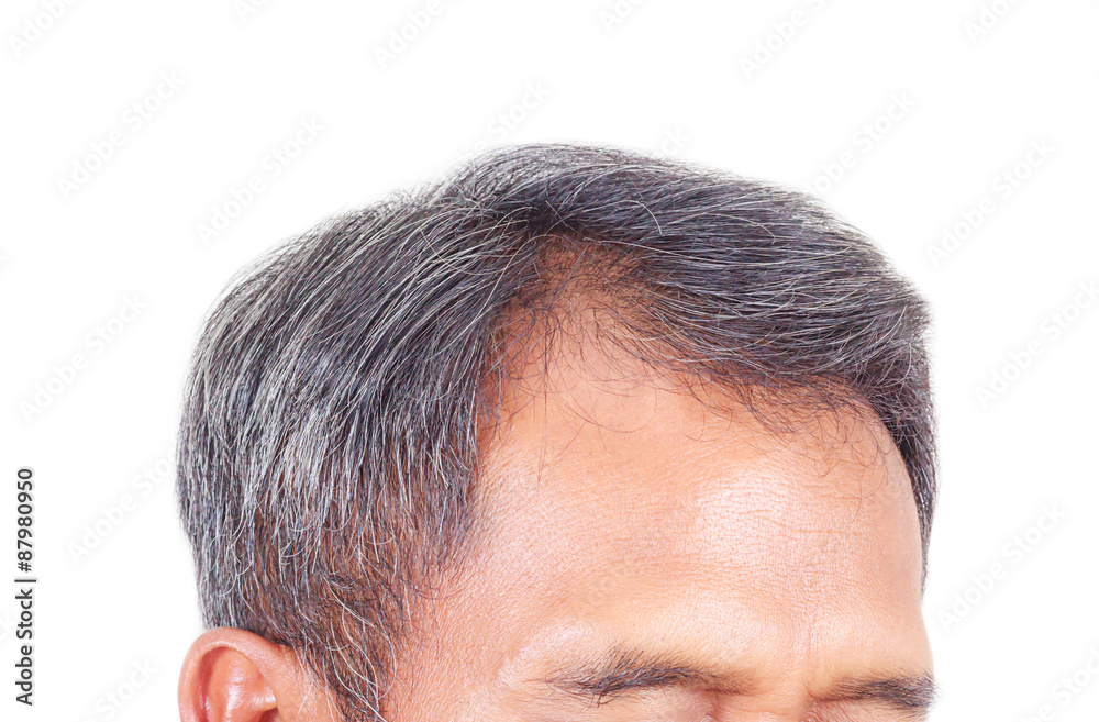 hair loss and grey hair, Male head with hair loss symptoms front