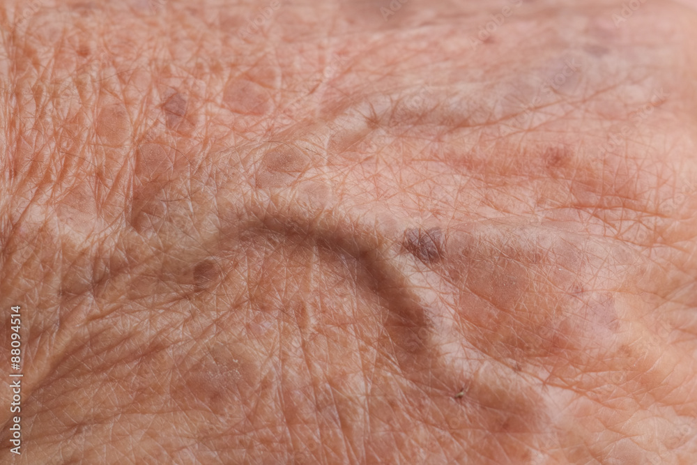 Fototapeta premium old woman skin blood vessel