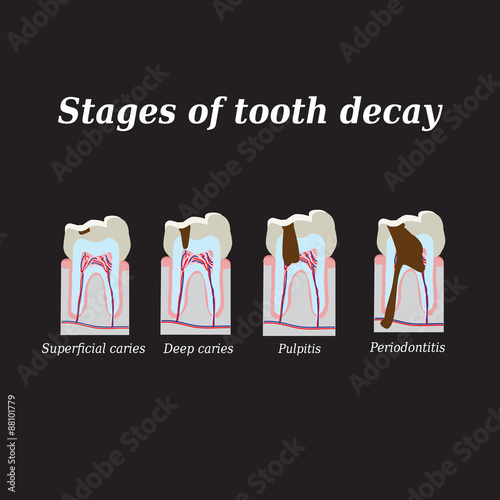 Stages of development of dental caries. Vector illustration on a