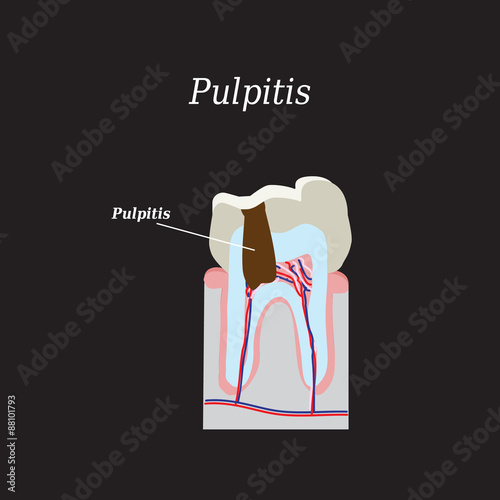 Dental pulp. Vector illustration on a black background