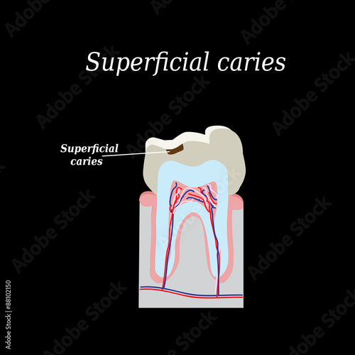 Home tooth caries. Vector illustration on a black background