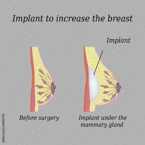 The implant in the breast on a gray background