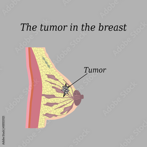 The tumor in the breast. On a gray background. The structure of