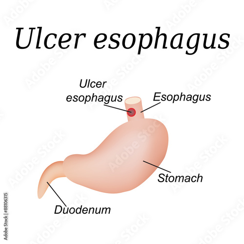 Esophagus ulcer affected. Ulcer of esophagus. Vector