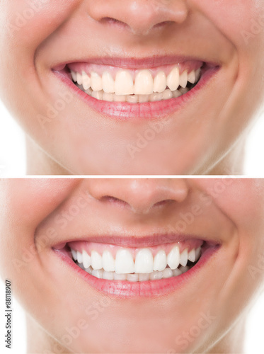 Before and after bleaching or whitening