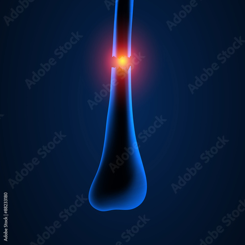 x-ray image show fracture both bone
