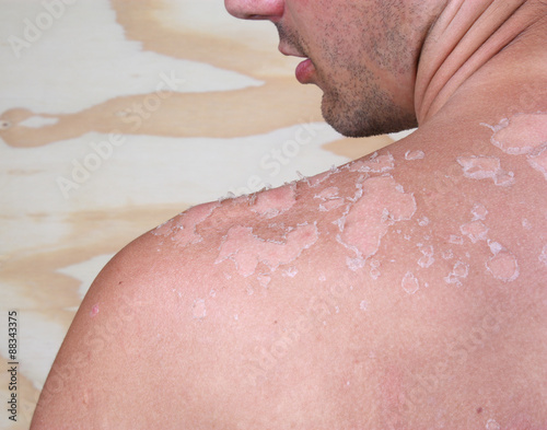 Sunburned male back