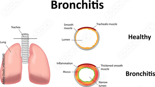 Photos Bronchitis Illustration,