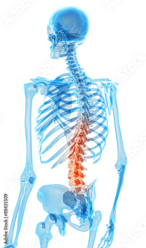 medically accurate illustration - painful back