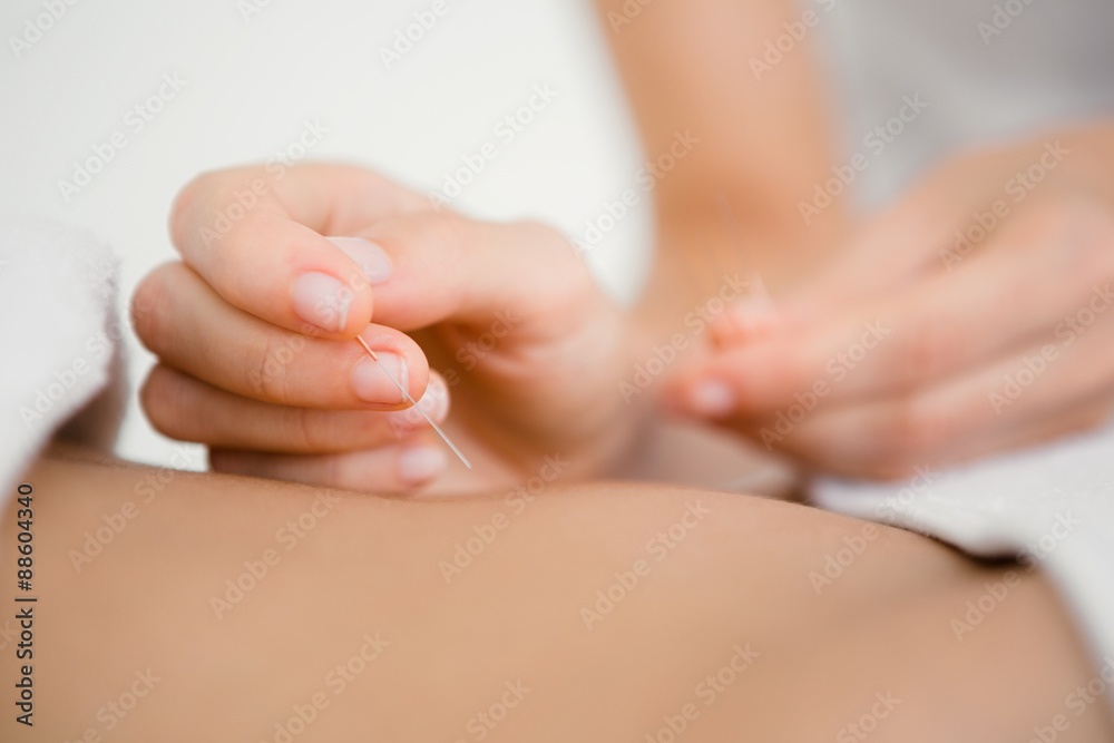 Woman holding a needle in an acupuncture therapy Woman holding a needle in an acupuncture therapy