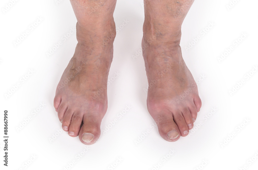 Old woman with varicose veins