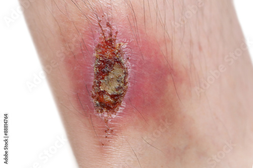 Photos wounded leg in white background