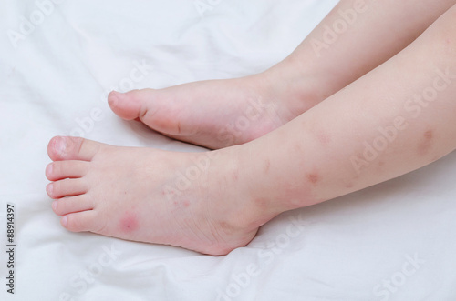 Mosquito bites sore on baby legs