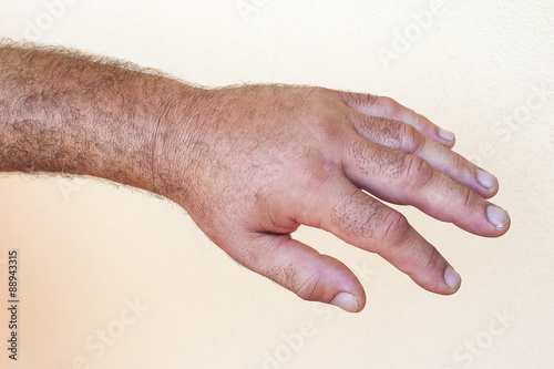 Mosquito bite