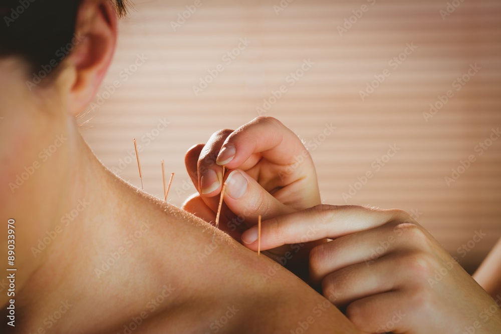 Young woman getting acupuncture treatment - obrazy, fototapety, plakaty 