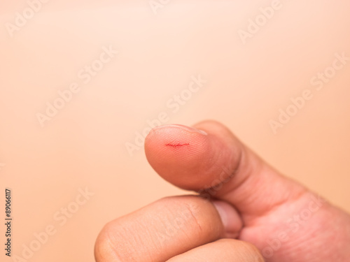Thumb cut wound