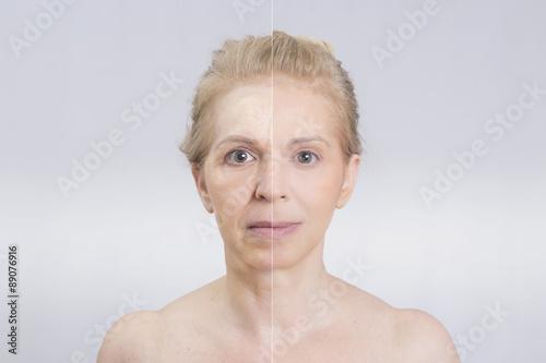 Woman before and after skin treatment 