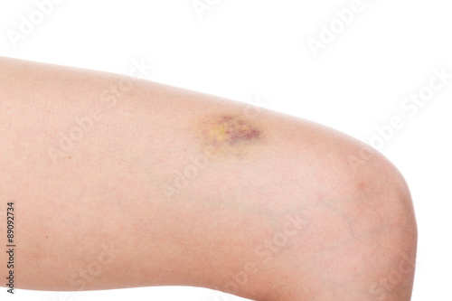Woman leg with pain and a large bruise