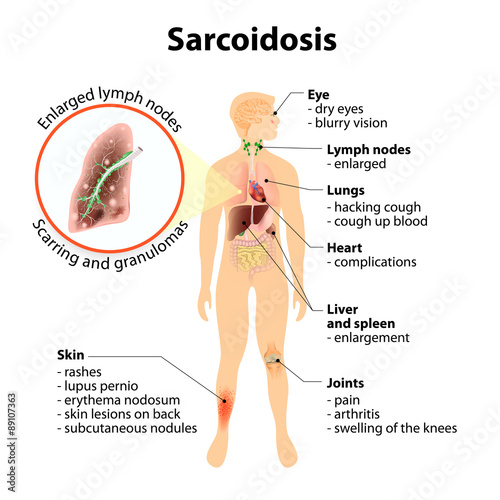 Sarcoidosis signs and symptoms photo