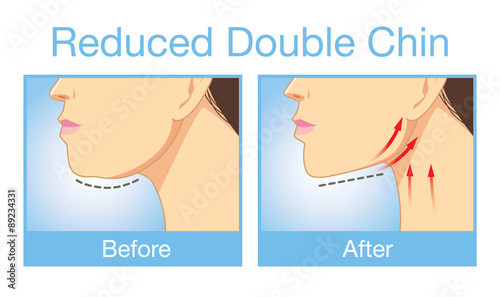 Illustration before and after reduce a double chin. Look firming up in after image.